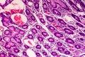 Poorly differentiated intestinal adenocarcinoma , light micrograph Royalty Free Stock Photo