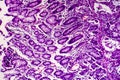 Poorly differentiated intestinal adenocarcinoma , light micrograph Royalty Free Stock Photo