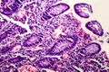 Poorly differentiated intestinal adenocarcinoma , light micrograph