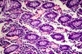 Poorly differentiated intestinal adenocarcinoma , light micrograph Royalty Free Stock Photo
