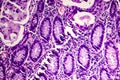 Poorly differentiated intestinal adenocarcinoma , light micrograph