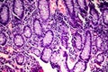 Poorly differentiated intestinal adenocarcinoma , light micrograph Royalty Free Stock Photo