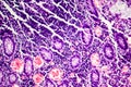 Poorly differentiated intestinal adenocarcinoma , light micrograph