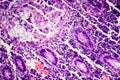 Poorly differentiated intestinal adenocarcinoma , light micrograph