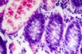 Poorly differentiated intestinal adenocarcinoma , light micrograph Royalty Free Stock Photo