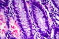 Poorly differentiated intestinal adenocarcinoma , light micrograph