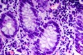 Poorly differentiated intestinal adenocarcinoma , light micrograph Royalty Free Stock Photo