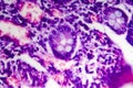 Poorly differentiated intestinal adenocarcinoma , light micrograph