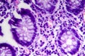 Poorly differentiated intestinal adenocarcinoma , light micrograph