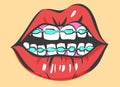 Pop Art Lips With Dental Braces.