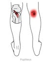 Popliteus Myofascial Trigger points cause pain at the back of the knee.