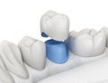 Porcelain crown placement over premolar tooth. Medically accurate 3D illustration Royalty Free Stock Photo