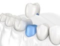 Porcelain crown placement over premolar tooth. Medically accurate 3D illustration Royalty Free Stock Photo