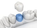 Porcelain crown placement over premolar tooth. Medically accurate 3D illustration Royalty Free Stock Photo