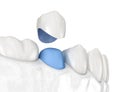 Porcelain crown placement over premolar tooth. Medically accurate 3D illustration Royalty Free Stock Photo