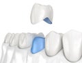 Porcelain crown placement over premolar tooth. Medically accurate 3D illustration Royalty Free Stock Photo