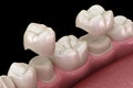 Porcelain crowns placement over premolar and molar teeth. . Medically accurate 3D illustration