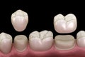 Porcelain crowns placement over premolar and molar teeth. . Medically accurate 3D illustration