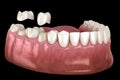 Porcelain crowns placement over premolar and molar teeth. . Medically accurate 3D illustration Royalty Free Stock Photo