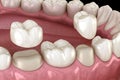 Porcelain crowns placement over premolar and molar teeth. Medically accurate 3D illustration Royalty Free Stock Photo