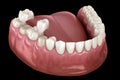 Porcelain crowns placement over premolar and molar teeth. Medically accurate 3D illustration