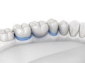 Porcelain Dental bridge of 3 teeth over molar and premolar. Medically accurate 3D illustration of human teeth treatment Royalty Free Stock Photo