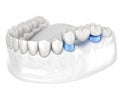 Porcelain Dental bridge of 3 teeth over molar and premolar. Medically accurate 3D illustration of human teeth treatment Royalty Free Stock Photo