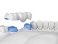 Porcelain Dental bridge of 3 teeth over molar and premolar. Medically accurate 3D illustration of human teeth treatment Royalty Free Stock Photo