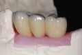 A porcelain fuse to metal dental bridge with high translucency porcelain which mimic the natural teeth color Royalty Free Stock Photo