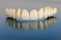 Porcelain teeth - dental bridge Royalty Free Stock Photo