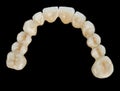 Porcelain teeth - dental bridge Royalty Free Stock Photo