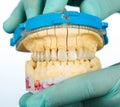 Porcelain teeth - dental bridge Royalty Free Stock Photo