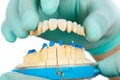 Porcelain teeth - dental bridge Royalty Free Stock Photo