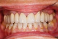 Porcelain teeth in human mouth