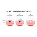Pore Cleansing Process: A Step-by-Step Visual Guide Royalty Free Stock Photo