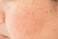 Pores on the face in women