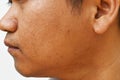 Pores and oily on surface young asian man face skin do not take care for a long time Royalty Free Stock Photo