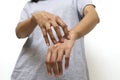 Allergy. Itchy skin. Women`s hands are scratched, on white background