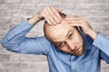 Portrait of a bald man looking at his balding head with a short haircut in a blue shirt. Hair transplant concept: white sad Royalty Free Stock Photo