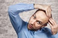 Portrait of a bald man looking at his balding head with a short haircut in a blue shirt. Hair transplant concept: white sad Royalty Free Stock Photo