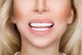 Portrait of a beautiful, smiling blond woman model with very white teetho