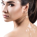 Portrait of beautiful woman with vitiligo. Royalty Free Stock Photo