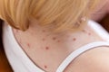 A portrait of the body of a small toddler with the chicken or wind pox dissease. The contagious illness comes with red spots all Royalty Free Stock Photo