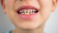 Portrait of a boy in pajamas, bad teeth, closeup Royalty Free Stock Photo