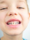 Portrait of a boy in pajamas bad teeth, closeup Royalty Free Stock Photo