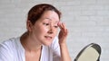 Portrait of a Caucasian woman with vitiligo diseas uses sunscreen