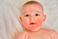 Portrait of a happy infant baby with allergies, red skin dermatitis Royalty Free Stock Photo