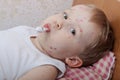 Portrait of little boy with chickenpox Royalty Free Stock Photo