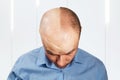 Portrait Man before and after hair loss, transplant. Split personality Royalty Free Stock Photo