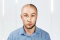 Portrait Man before and after hair loss, transplant. Split personality Royalty Free Stock Photo